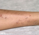 prurigo nodularis