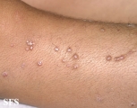 prurigo nodularis