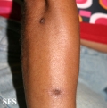 prurigo nodularis