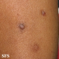 prurigo nodularis