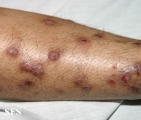 prurigo nodularis