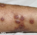prurigo nodularis