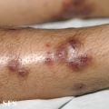 prurigo nodularis