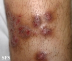 prurigo nodularis