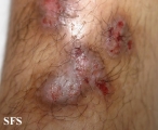 prurigo nodularis