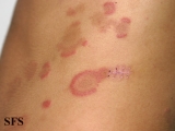 eosinophilic annular erythema
