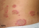 eosinophilic annular erythema