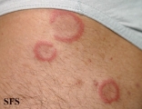 eosinophilic annular erythema