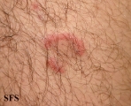 eosinophilic annular erythema