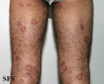 eosinophilic annular erythema