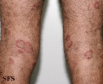 eosinophilic annular erythema
