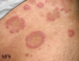 eosinophilic annular erythema