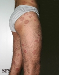 eosinophilic annular erythema
