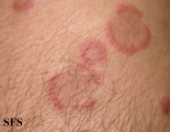 eosinophilic annular erythema