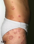 eosinophilic annular erythema