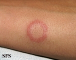 eosinophilic annular erythema