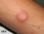 eosinophilic annular erythema