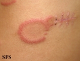 eosinophilic annular erythema
