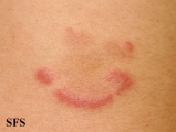 eosinophilic annular erythema