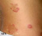 eosinophilic annular erythema