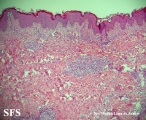 eosinophilic annular erythema