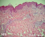eosinophilic annular erythema