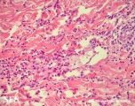 eosinophilic annular erythema