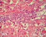 eosinophilic annular erythema