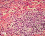 eosinophilic annular erythema