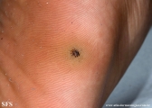 warts plantaris