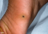 warts plantaris