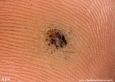 warts plantaris