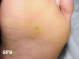 warts plantaris