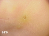 warts plantaris