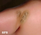 warts plantaris