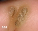 warts plantaris