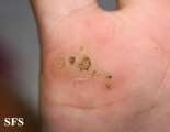warts plantaris