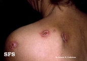 syphilis tertiary