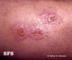 syphilis tertiary
