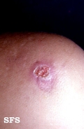 syphilis tertiary