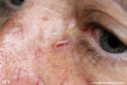 basal cell carcinoma