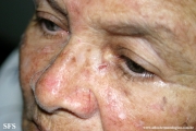 basal cell carcinoma