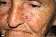 basal cell carcinoma