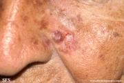 basal cell carcinoma