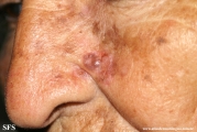 basal cell carcinoma