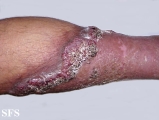 pyoderma gangrenosum