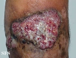 pyoderma gangrenosum