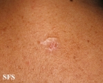 trichoepithelioma dermoplastic