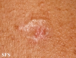 trichoepithelioma dermoplastic