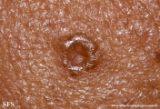 trichoepithelioma dermoplastic